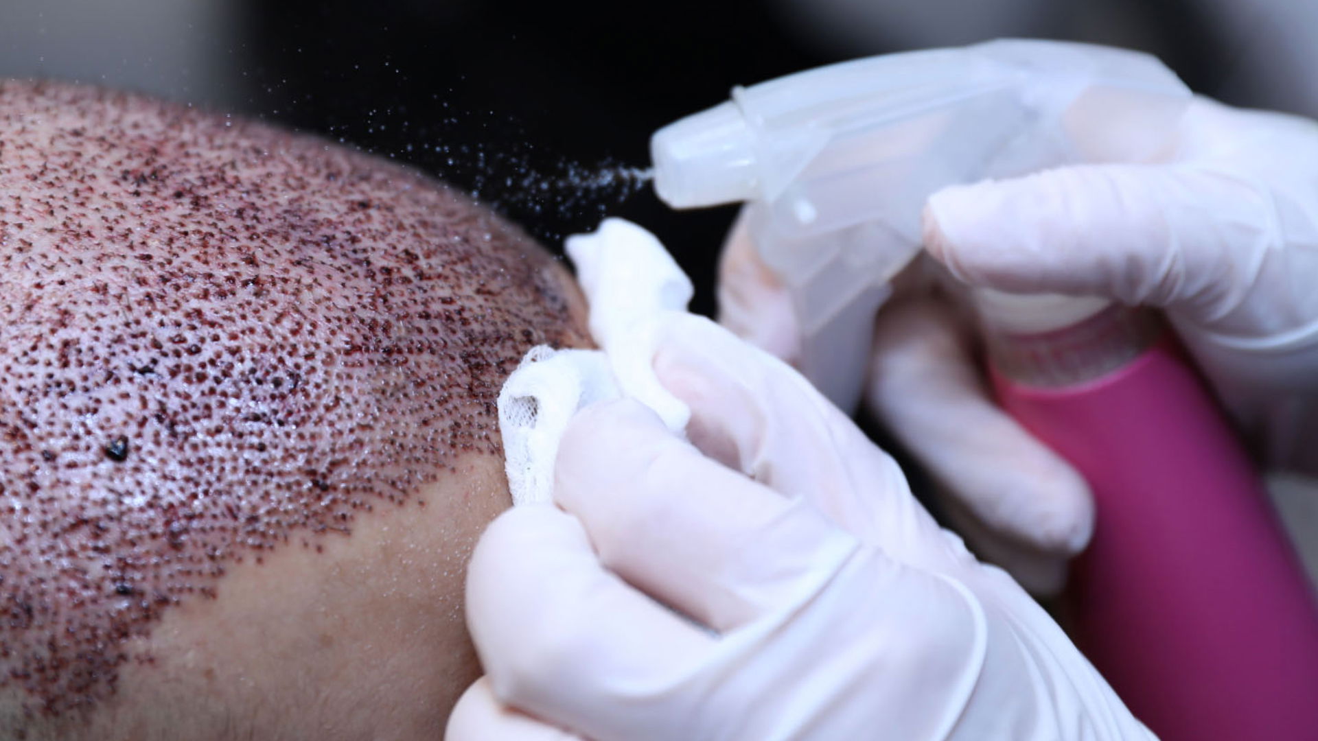 How Hair Transplants in Dubai Can Restore Your Confidence—Step-by-Step Guide