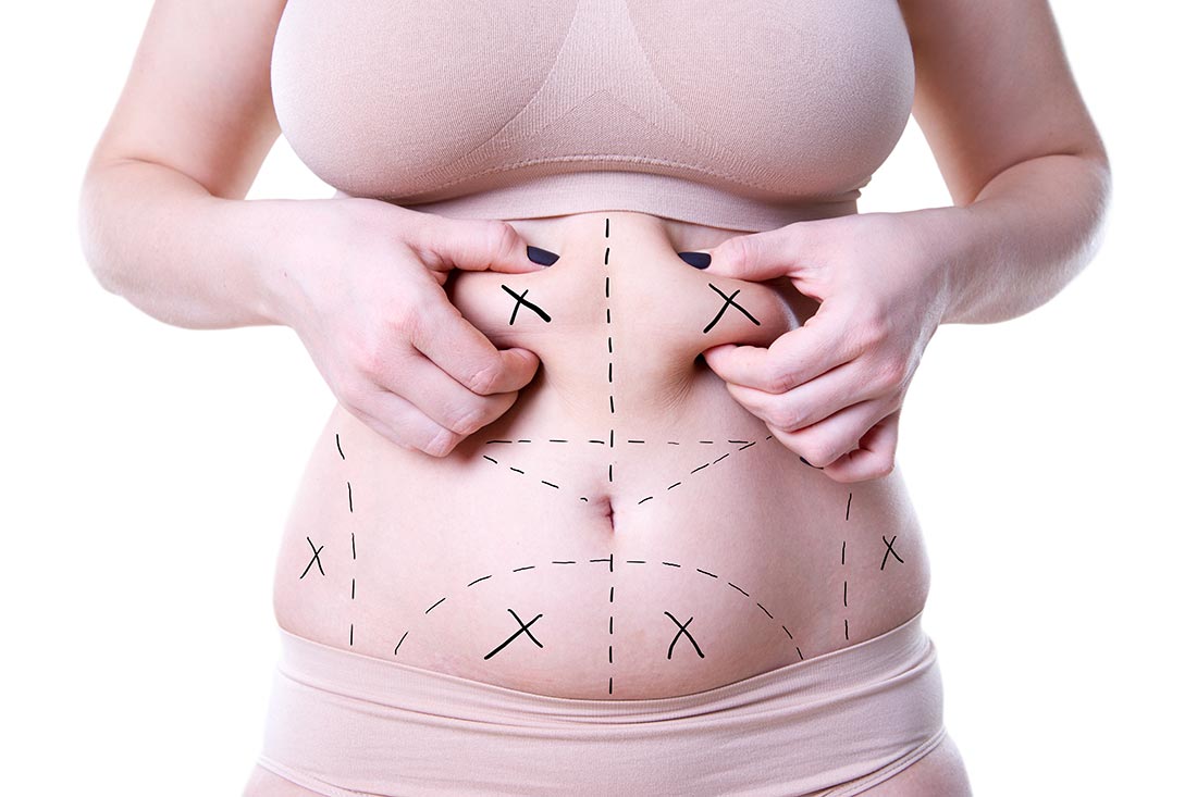 Slim and Snatch Your Midsection with Liposuction