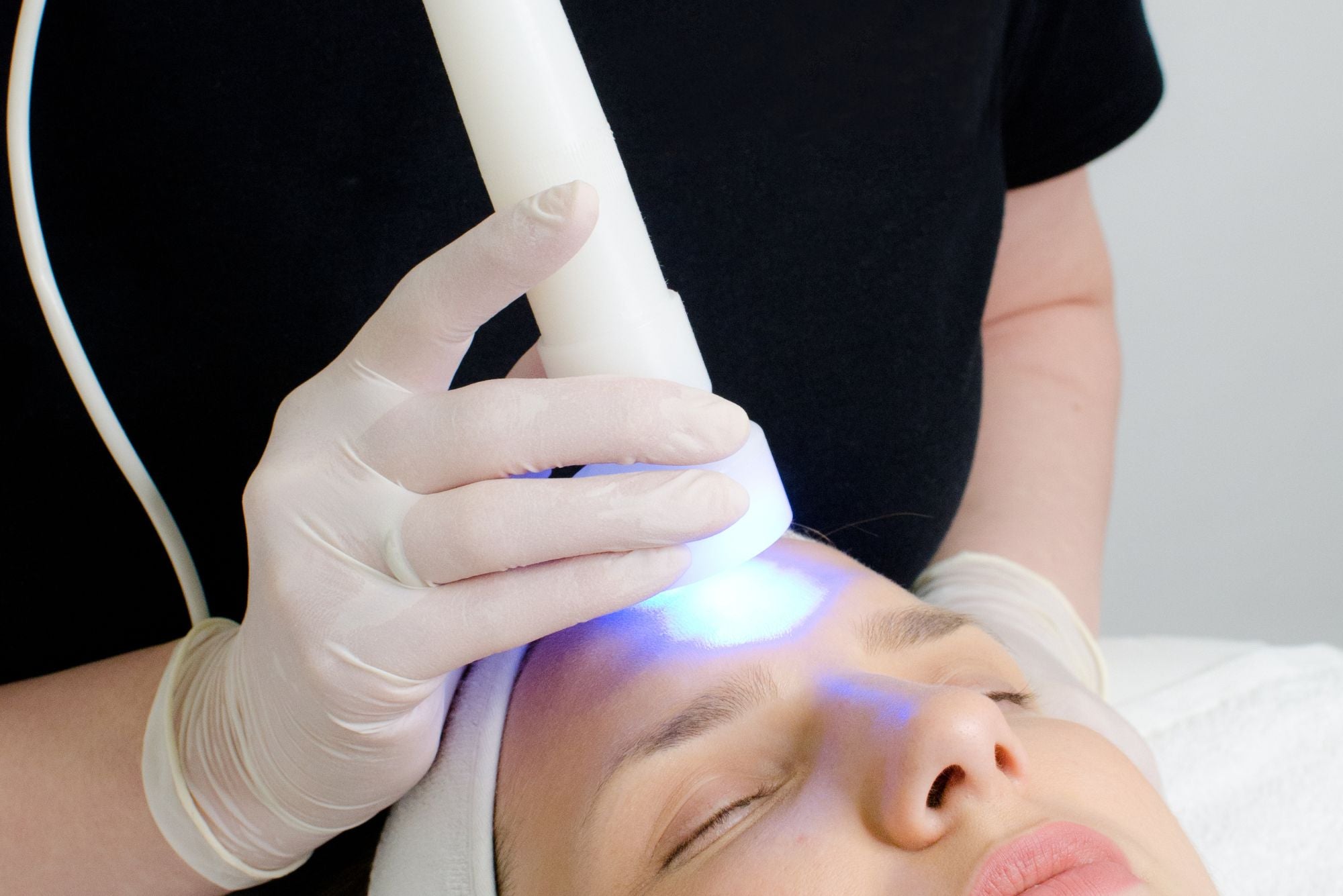 Fractional RF Microneedling: The Secret to Tighter, Brighter Skin