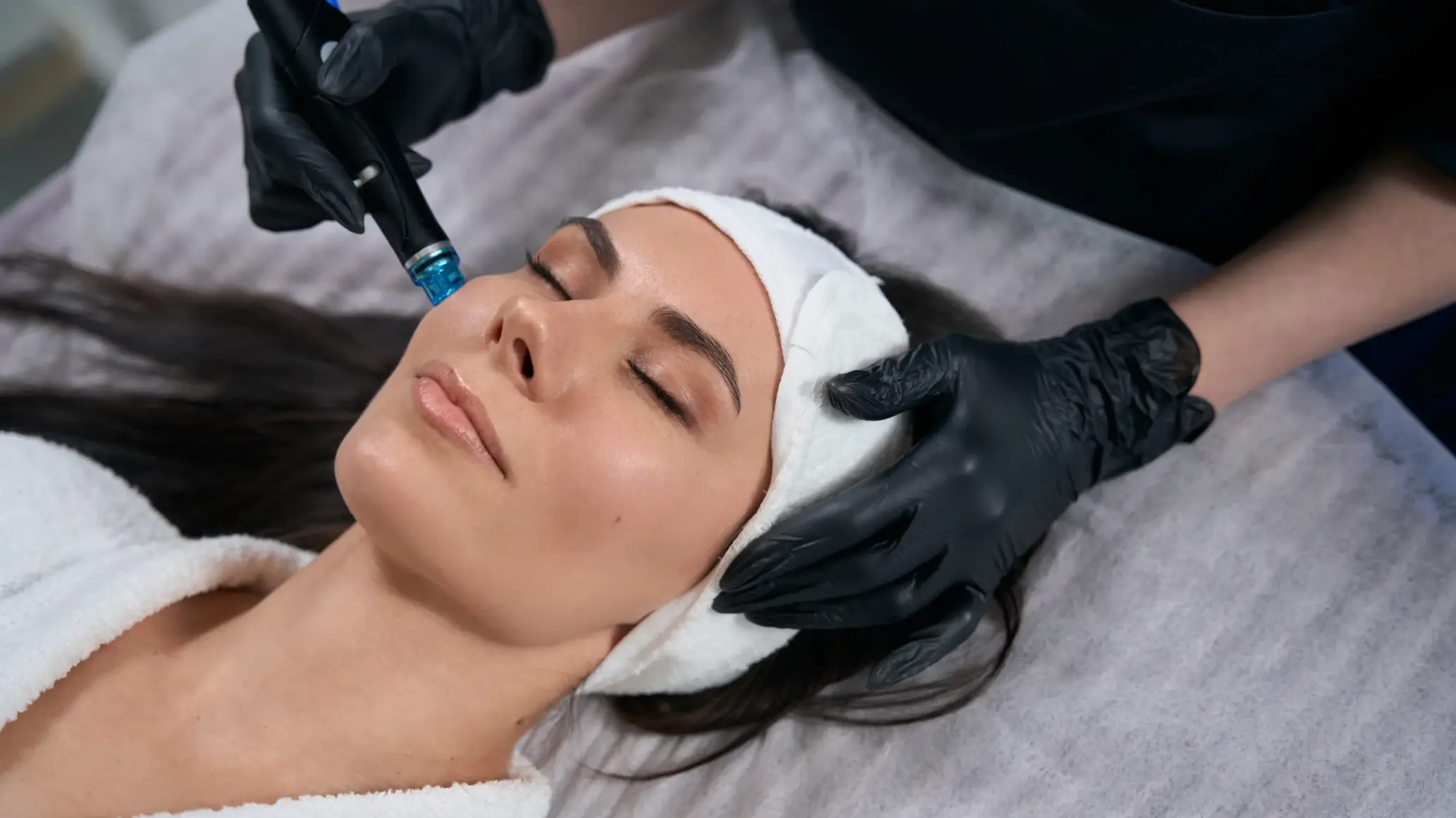 How Hydrafacial Helps Fight Acne and Reveal Clearer Skin