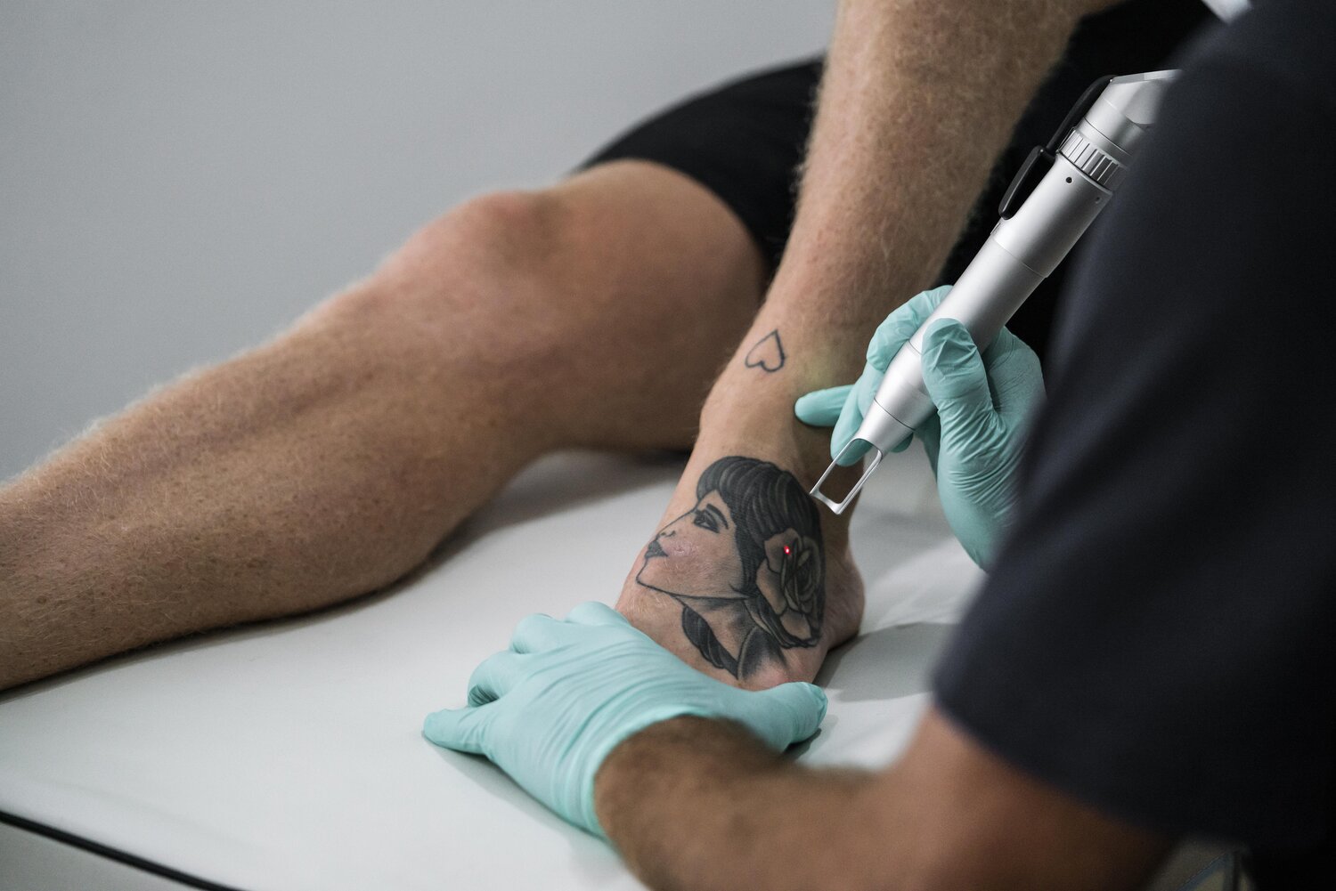 Laser Tattoo Removal That Handles Any Design
