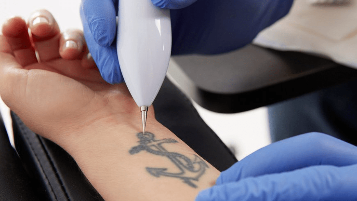 Dubai’s Choice for Clean Skin – Expert Laser Tattoo Removal