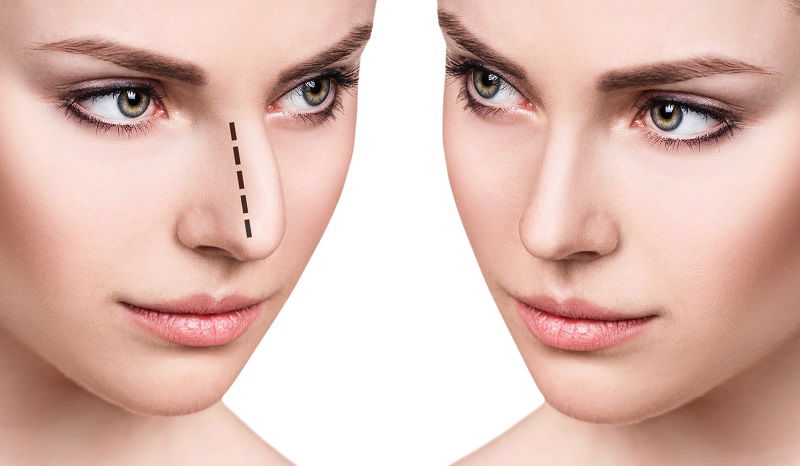 Minimally Invasive Rhinoplasty Cost in Dubai