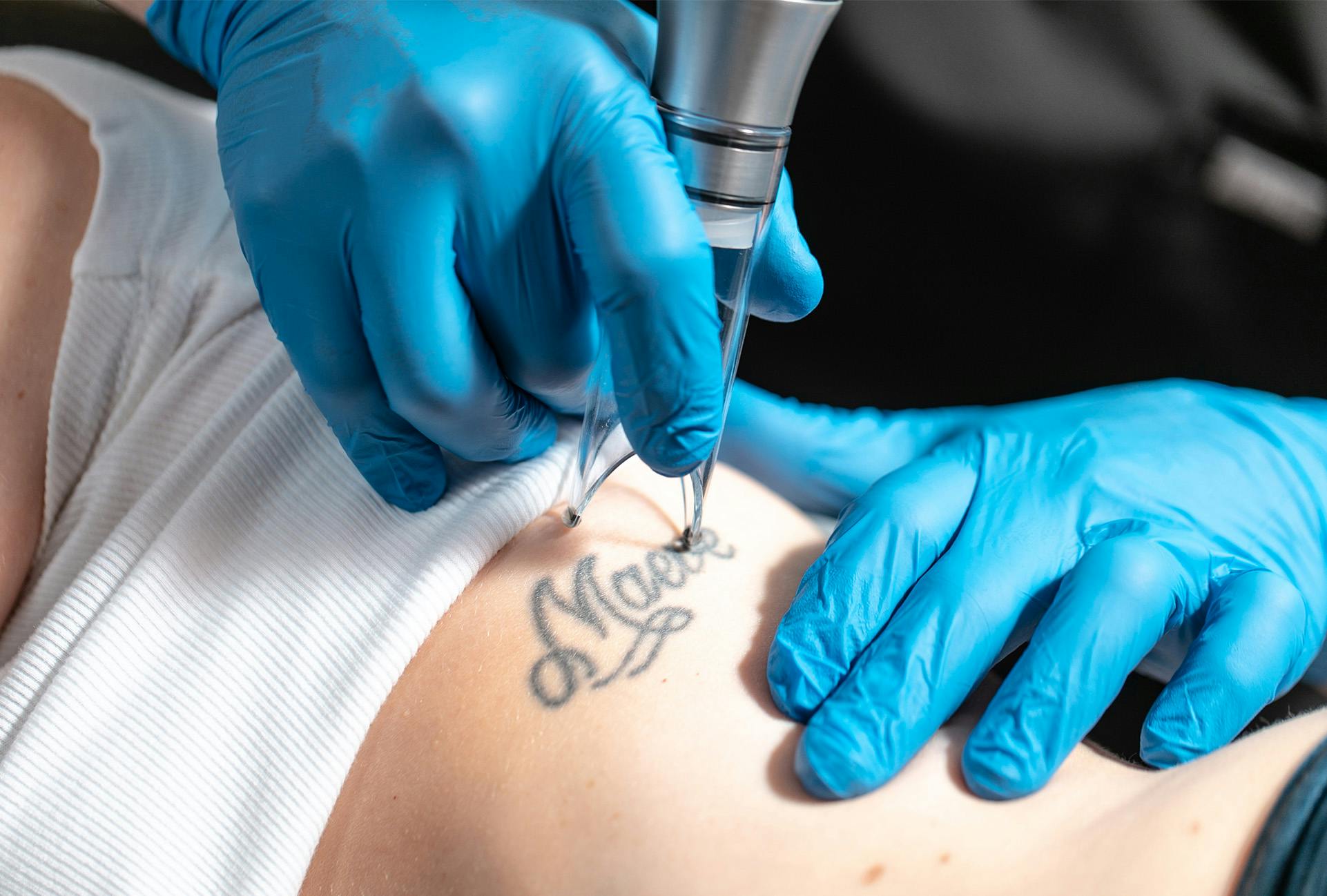 Benefits of Laser Tattoo Removal for Quickly Erasing Unwanted Tattoos