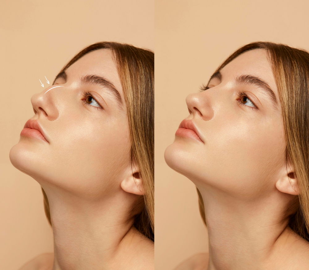Create That Iconic Look with Rhinoplasty Price in Dubai