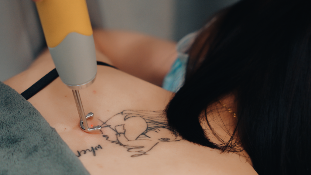 Laser Tattoo Removal Is a Bold Move for Fresh Skin