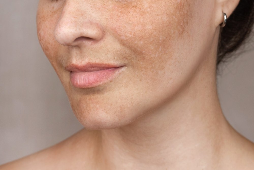 How To Remove Pigmentation From Face Permanently In Days