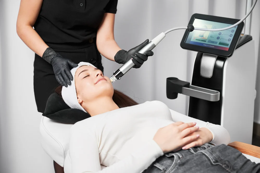 Fade Stretch Marks Fast with Fractional RF Microneedling!