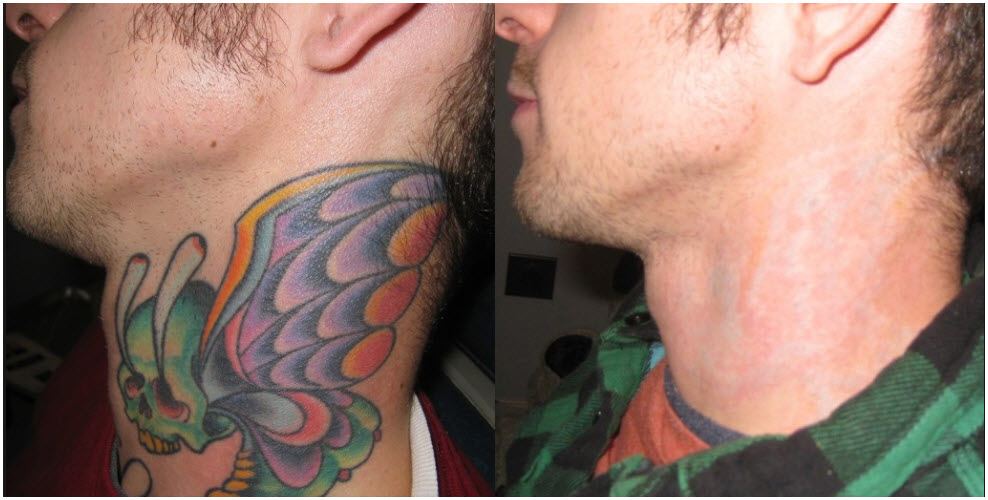 Laser Tattoo Removal Dubai That Gets Real Results Fast