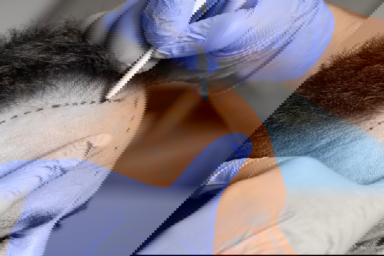 Elevate Your Look with Hair Transplant in Dubai Services