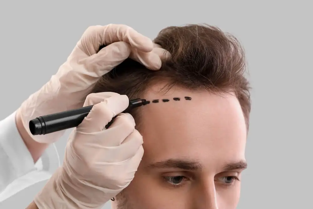 Make the Mirror Love You with Hair Transplant in Dubai