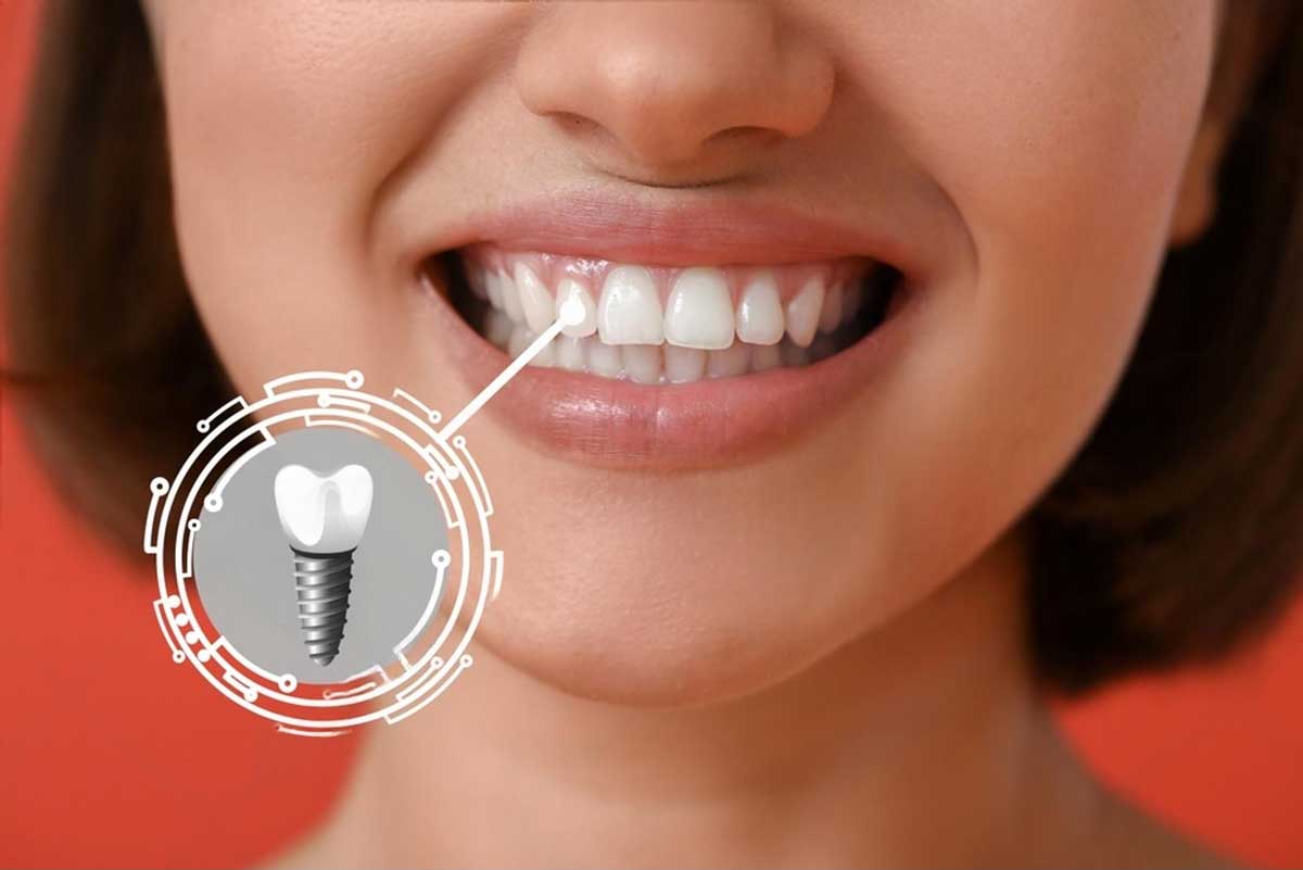 Smile Boldly Again with the Help of Dental Implants Dubai