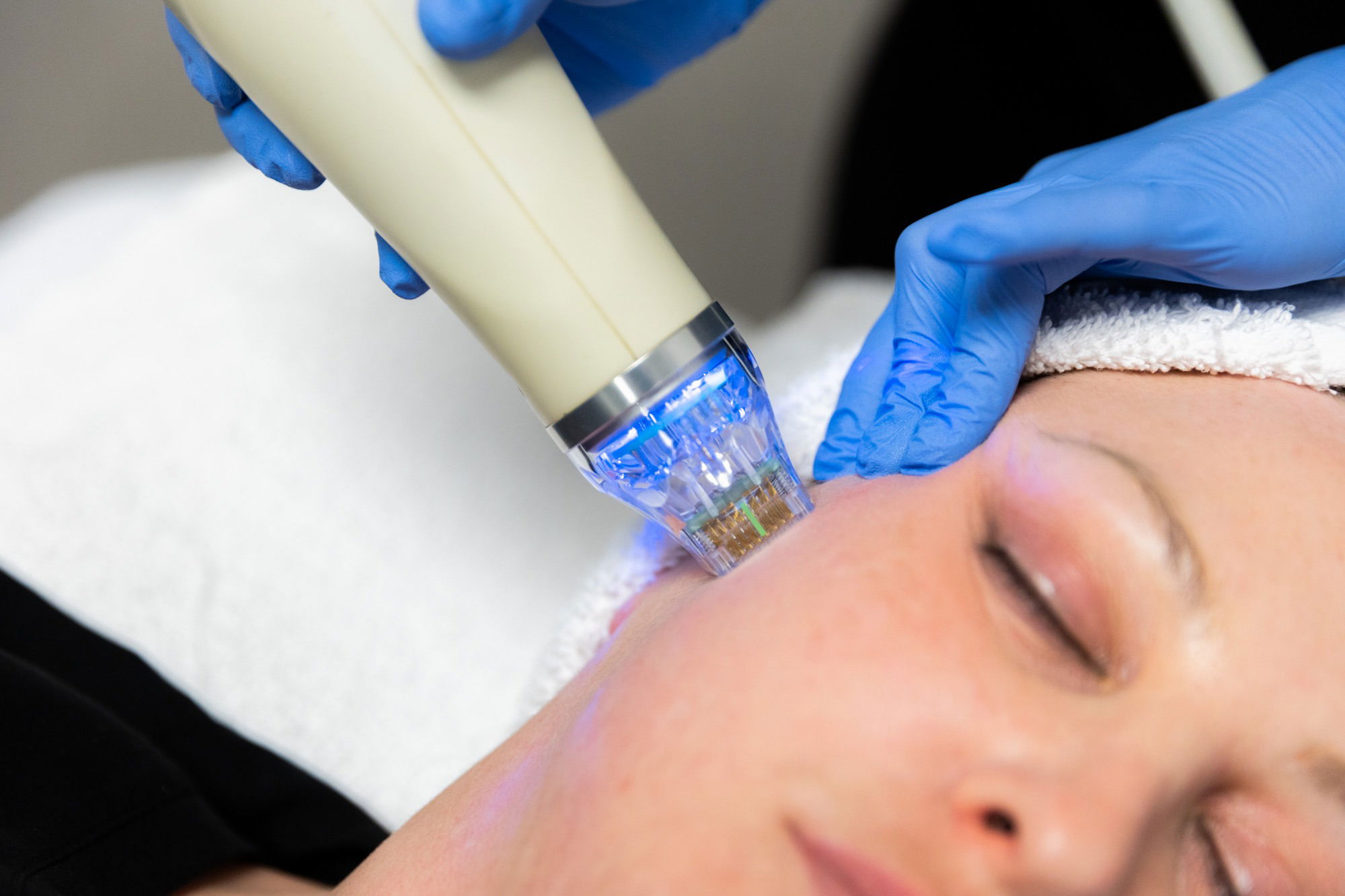 Fractional RF Microneedling Brings Out Your Best Glow Yet