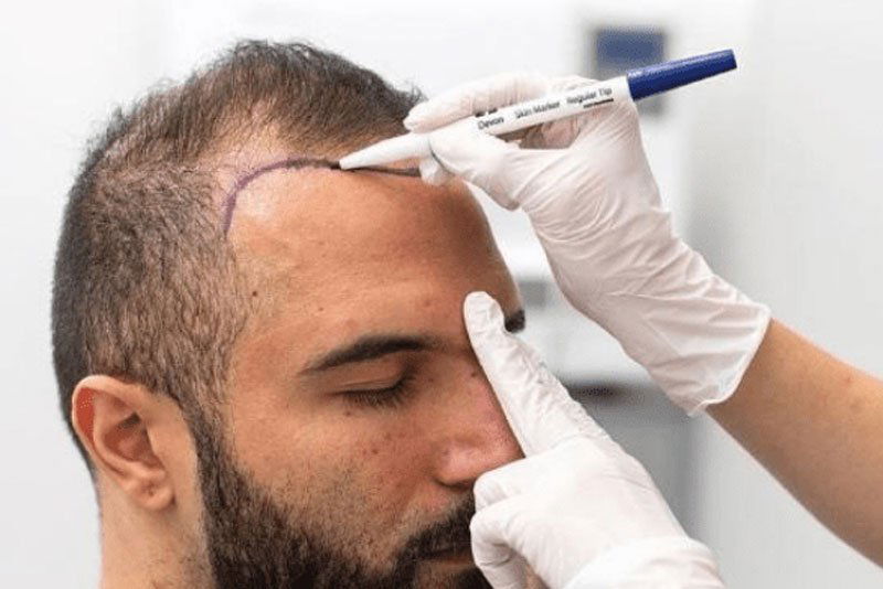 Hair Transplant Dubai for That Natural Regrowth Win