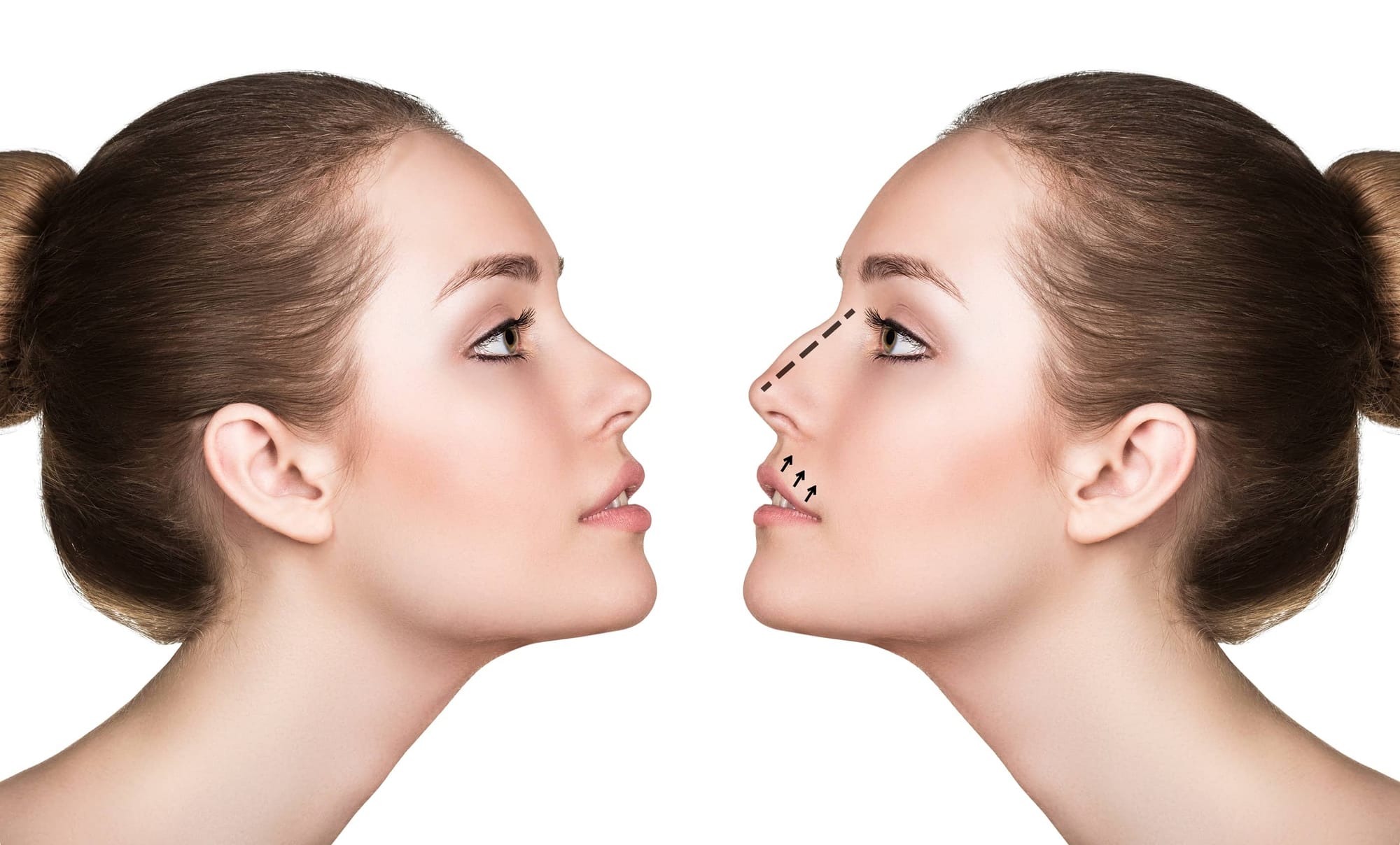 You Won’t Believe This Rhinoplasty Price in Dubai Trend