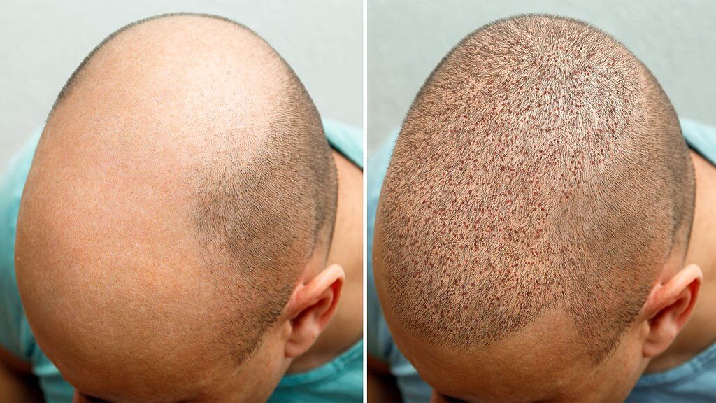 Hair Transplant That Makes Hairlines Fresh and Full