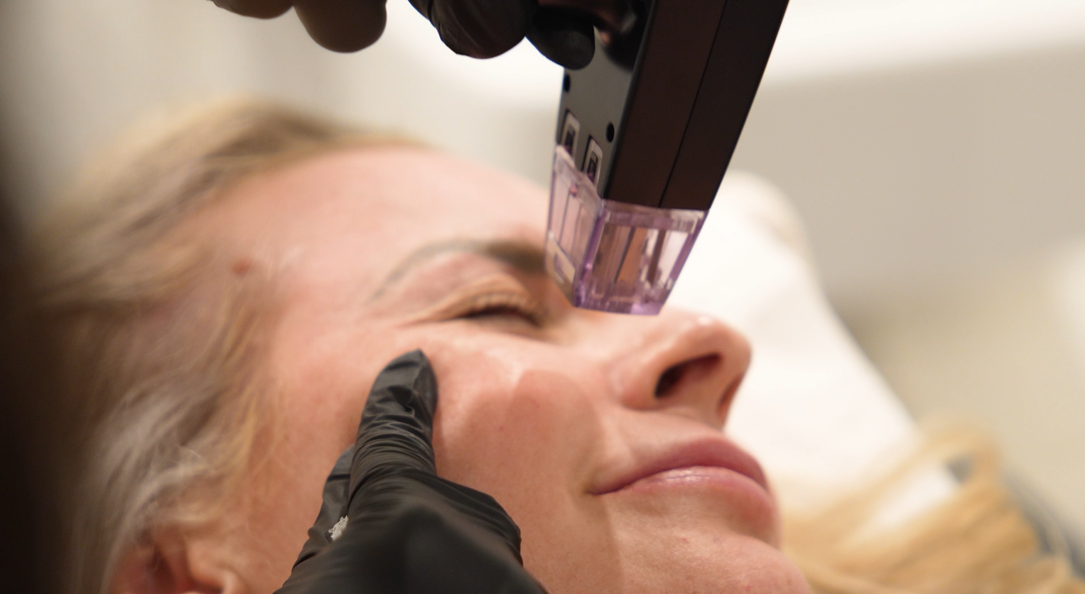 Morpheus8 Gives Every Angle of Your Face a Radiant Lift