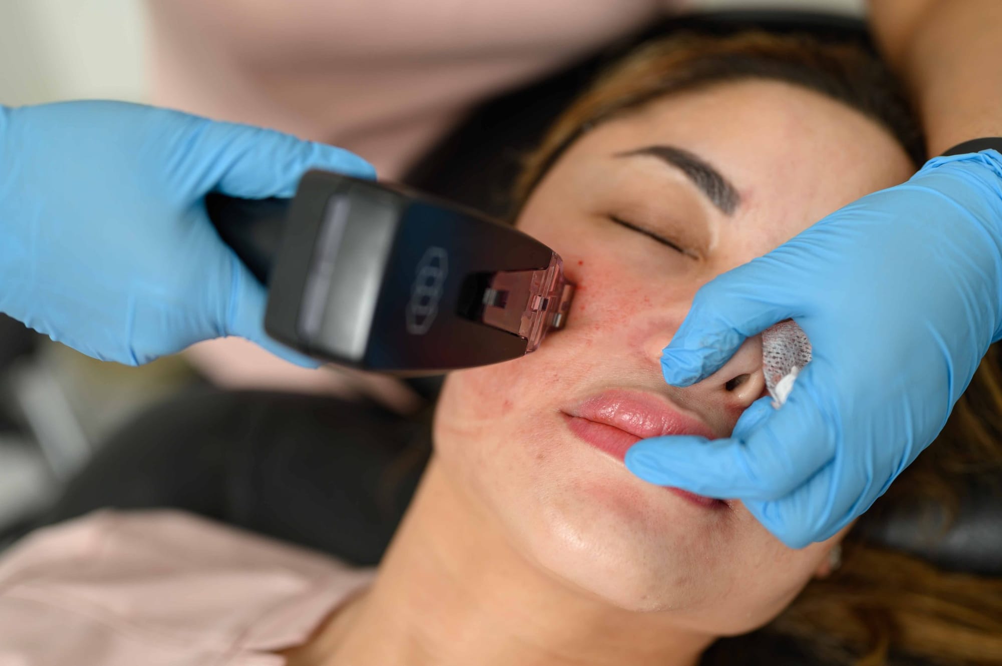 Achieve Head-Turning Radiance Fast with Morpheus8 Energy