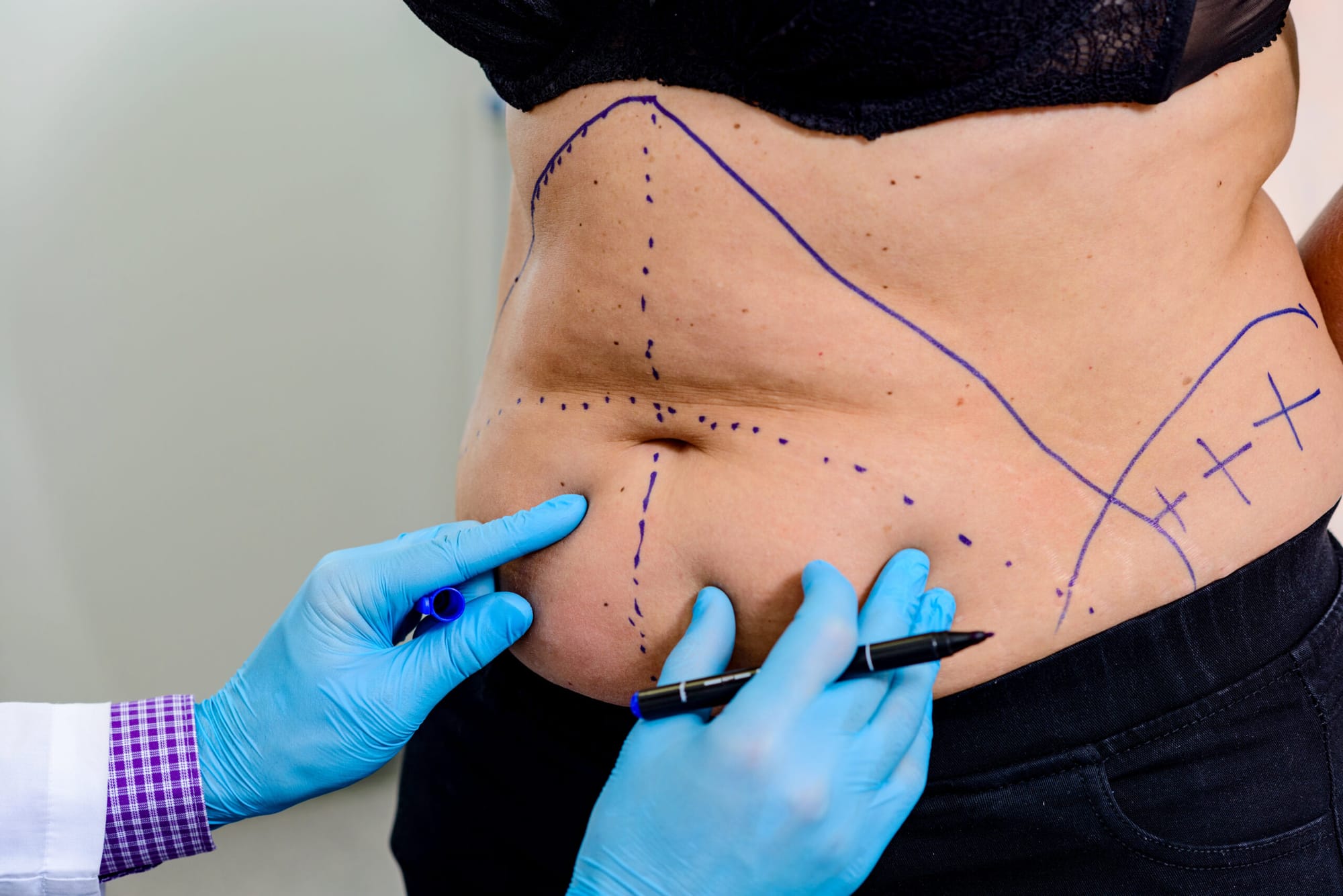 Liposuction in Dubai Unlocks Perfect Symmetry for Modern Confidence