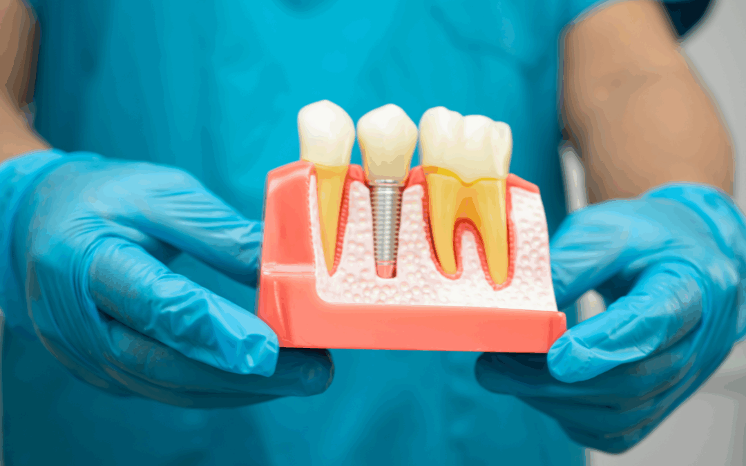 Do Dental Implants in Dubai improve the appearance of your smile?