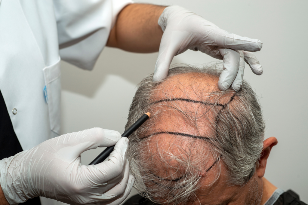 How Is Hair Transplant Procedure Timeline Explained for New Patients?