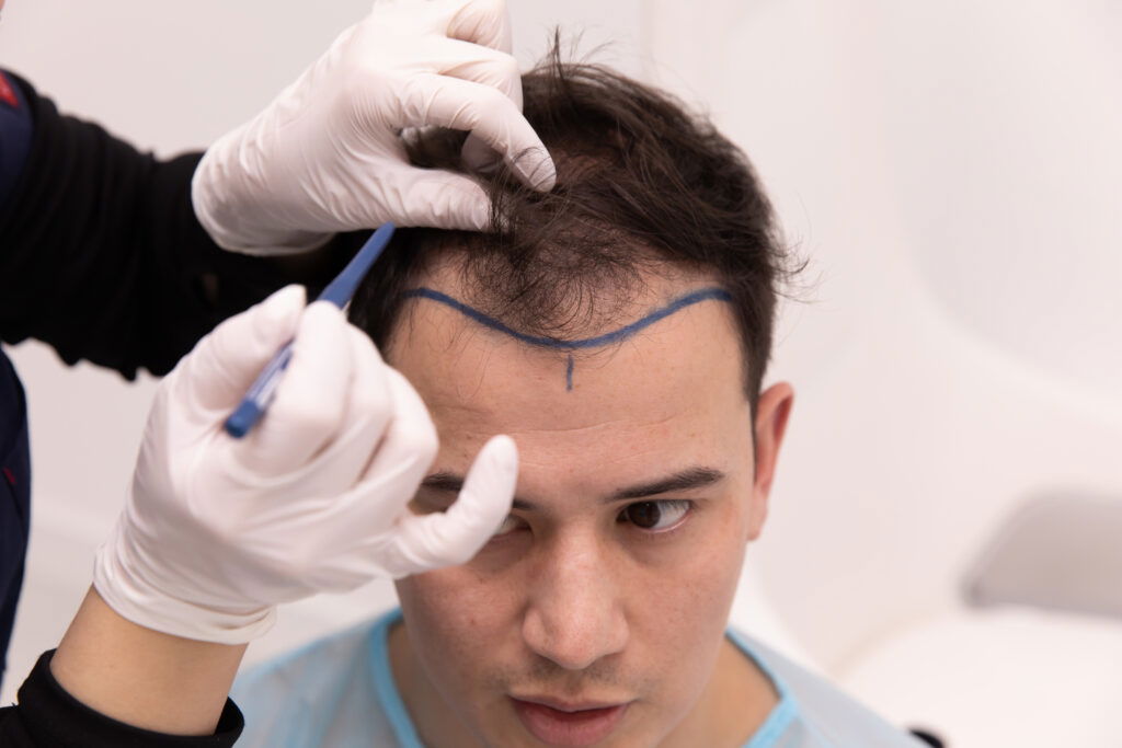 Hair Transplant in Dubai Benefits: Improving Appearance and Hair Density