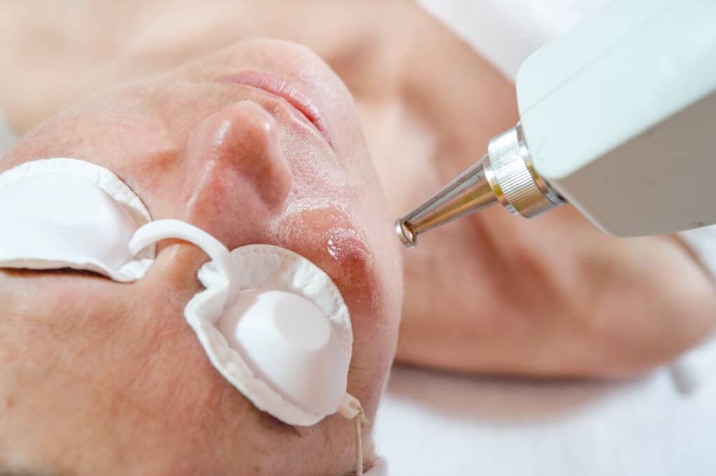 Your skin’s upgrade: PicoSure Laser Treatment for revitalised look