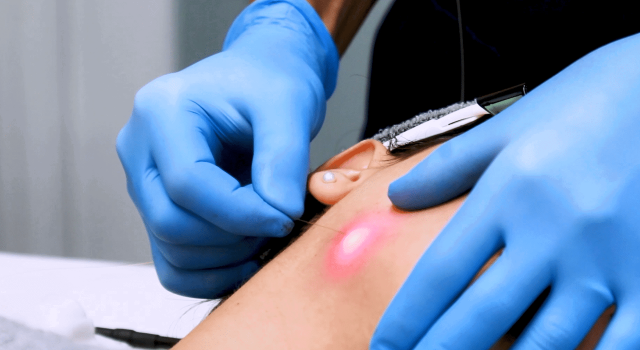 Experience Radiance and Youthful Skin Instantly with Endolift