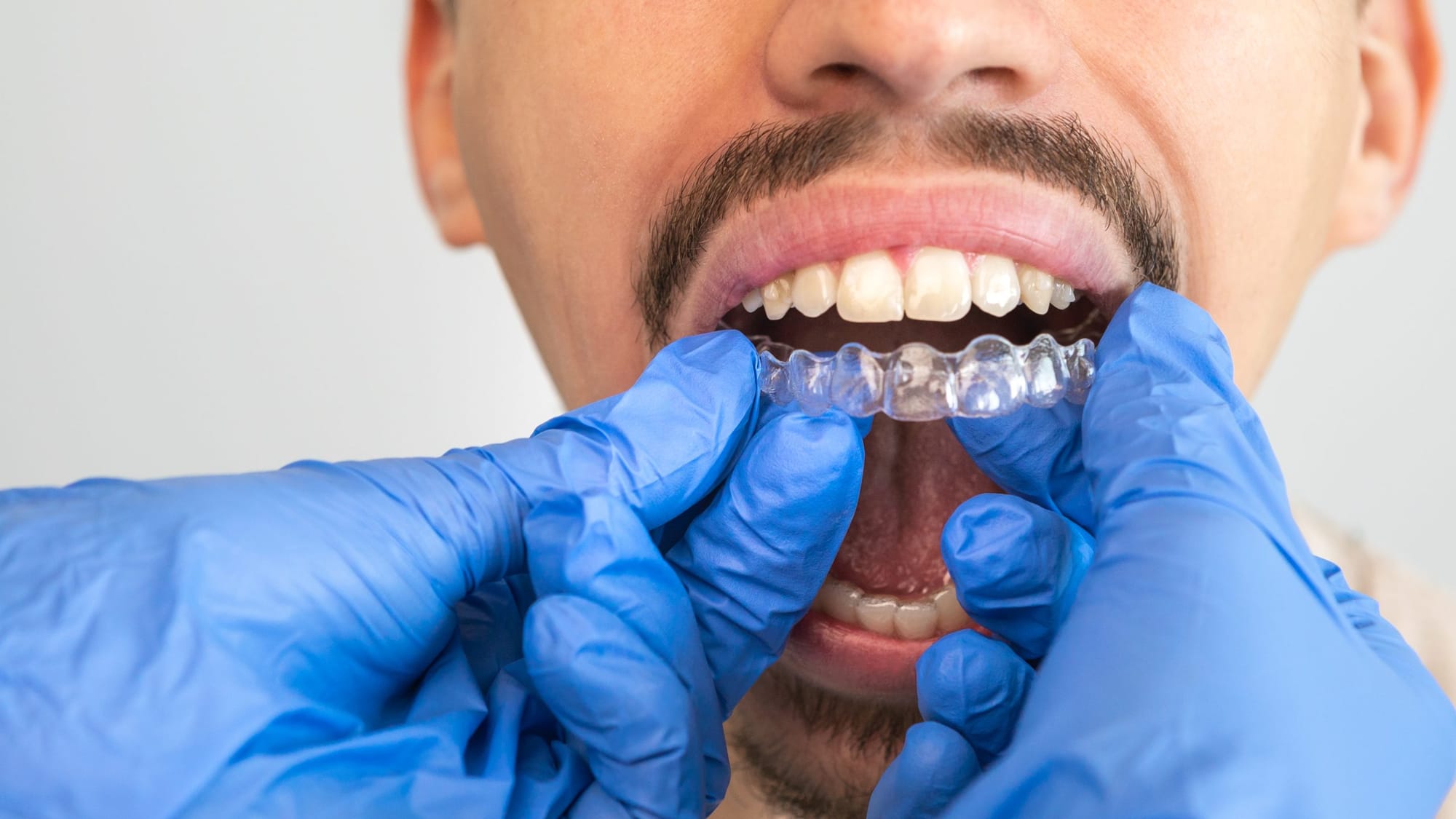Invisalign Braces Treatment Cost That Makes Smiles Look Effortless