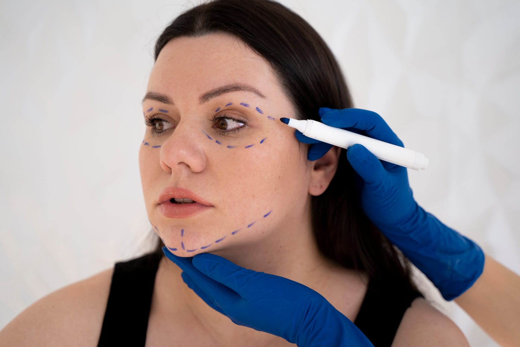 Thread Lift: Smooth, Firm, and Rejuvenated Skin Awaits