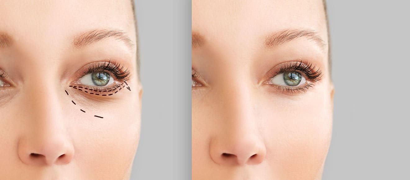 Clinics Known for Natural Results in Eye Bag Removal in Dubai