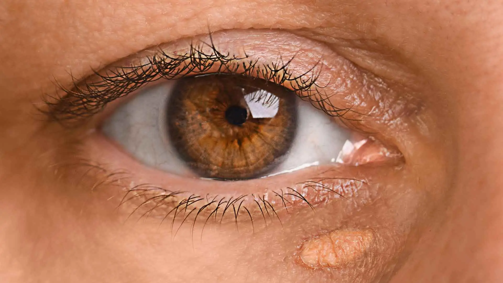 Reputable Clinics for Eyelid Xanthelasma Removal Solutions