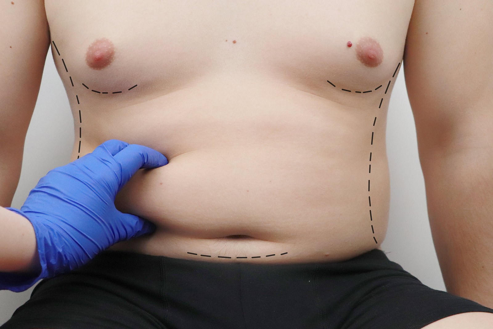 Can Six-Pack Abs Surgery Make Abdominal Muscles More Visible?