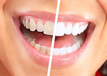 Brighten Your Smile with Teeth Whitening in Dubai