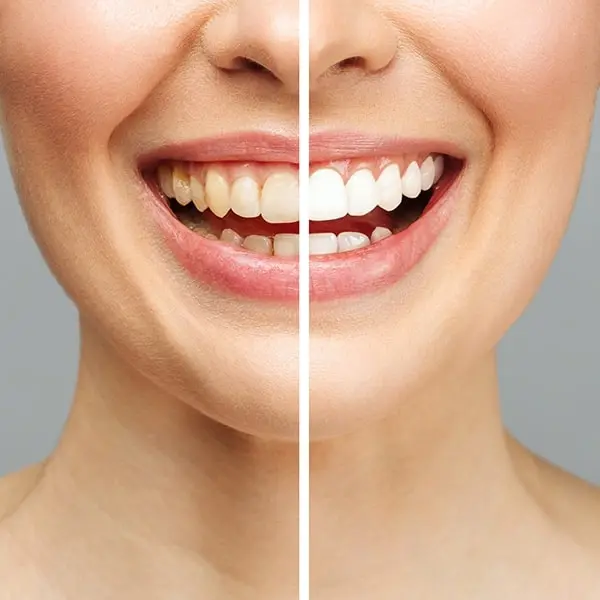 Revealing Brighter Smiles: Teeth Whitening in Dubai