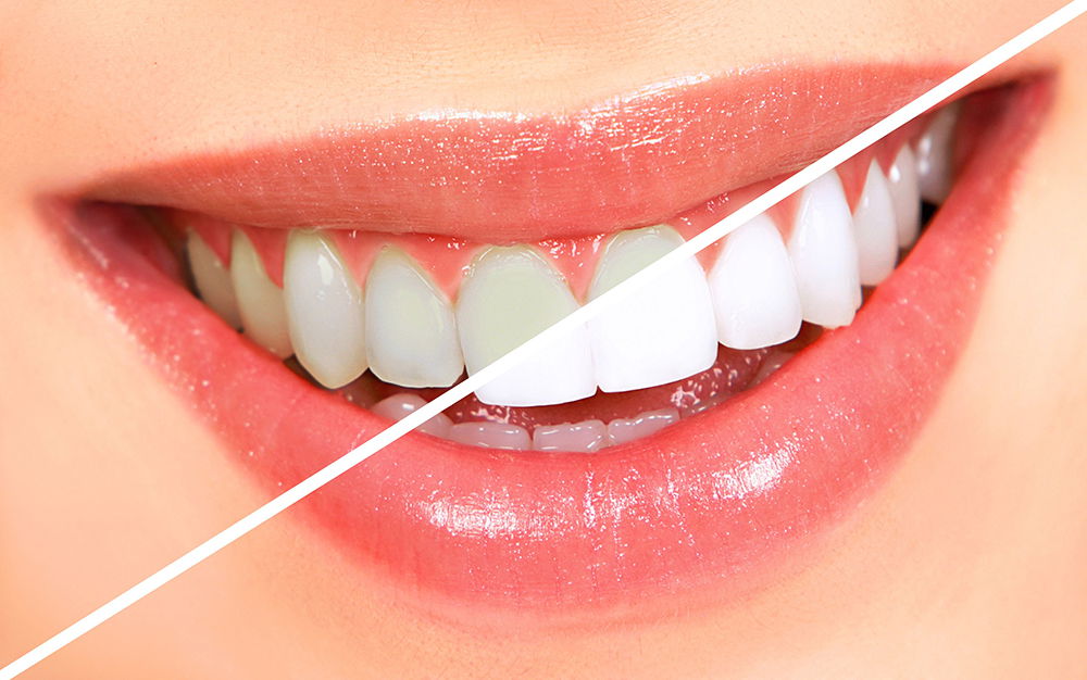 Revealing Brighter Smiles: Teeth Whitening in Dubai