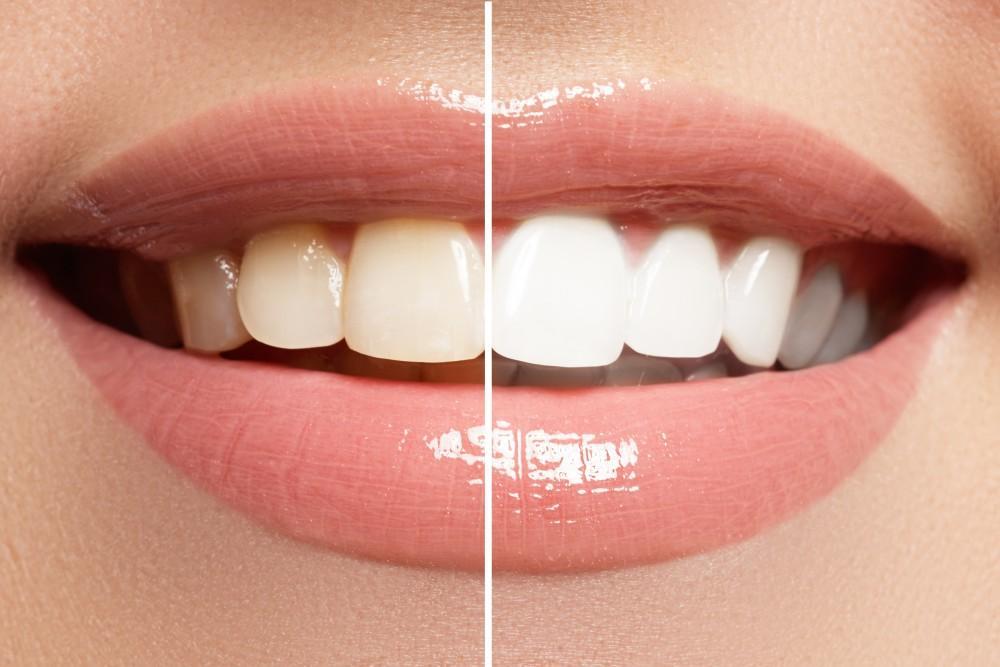 Safe and Effective Ways to Achieve a Stunning White Smile