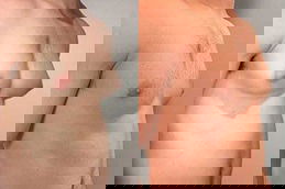 Achieve a Toned and Masculine Chest with Gynecomastia Treatment in Dubai