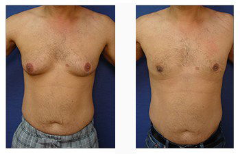 Achieve a Toned and Masculine Chest with Gynecomastia Treatment