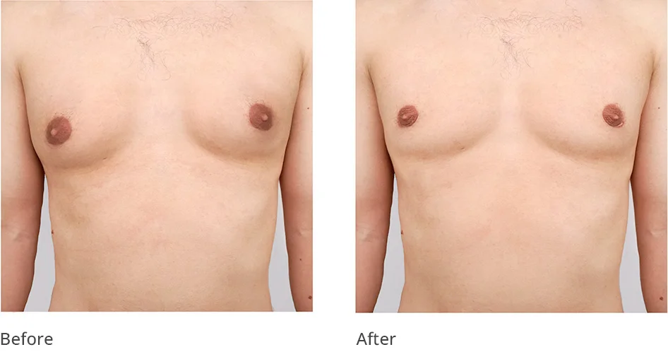 Best Surgical Solution for Male Breast Reduction