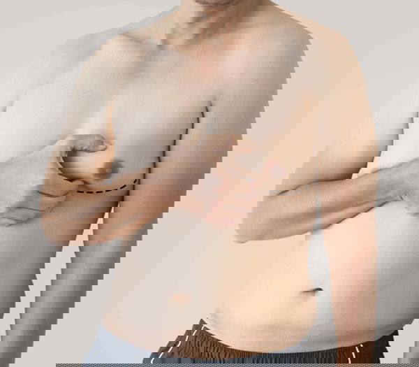 Gynecomastia Surgery for a Confident You