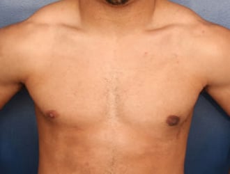 Best Ways to Reduce Male Breast Tissue