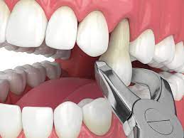 Say Goodbye to Troubled Teeth: A Guide to Tooth Removal in Dubai