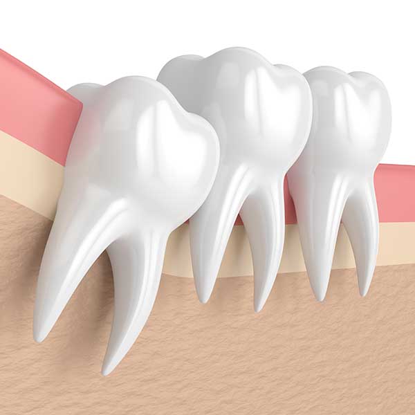 Painless Tooth Extraction: What to Expect in Dubai