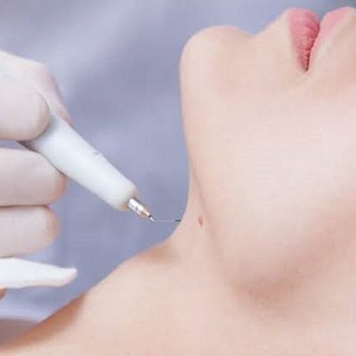 Smooth and Clear: How to Get Rid of Warts in Dubai
