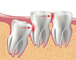 From Extraction to Replacement: Your Guide to a Healthy Smile
