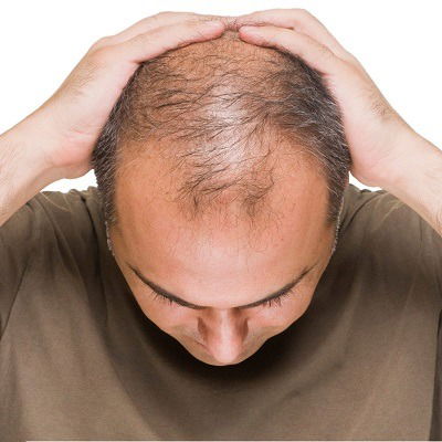 How Finasteride is Transforming Hair Restoration in Dubai