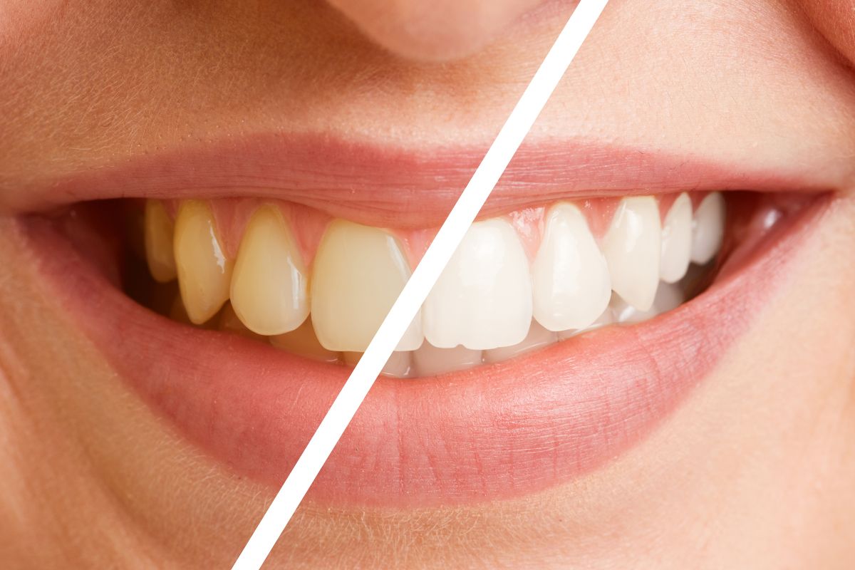 Brighten Your Smile with Teeth Whitening in Dubai