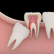Dubai Dentists Reveal Modern Tooth Extraction Techniques