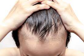 Struggling with Hair Loss? Discover the Power of Finasteride in Dubai